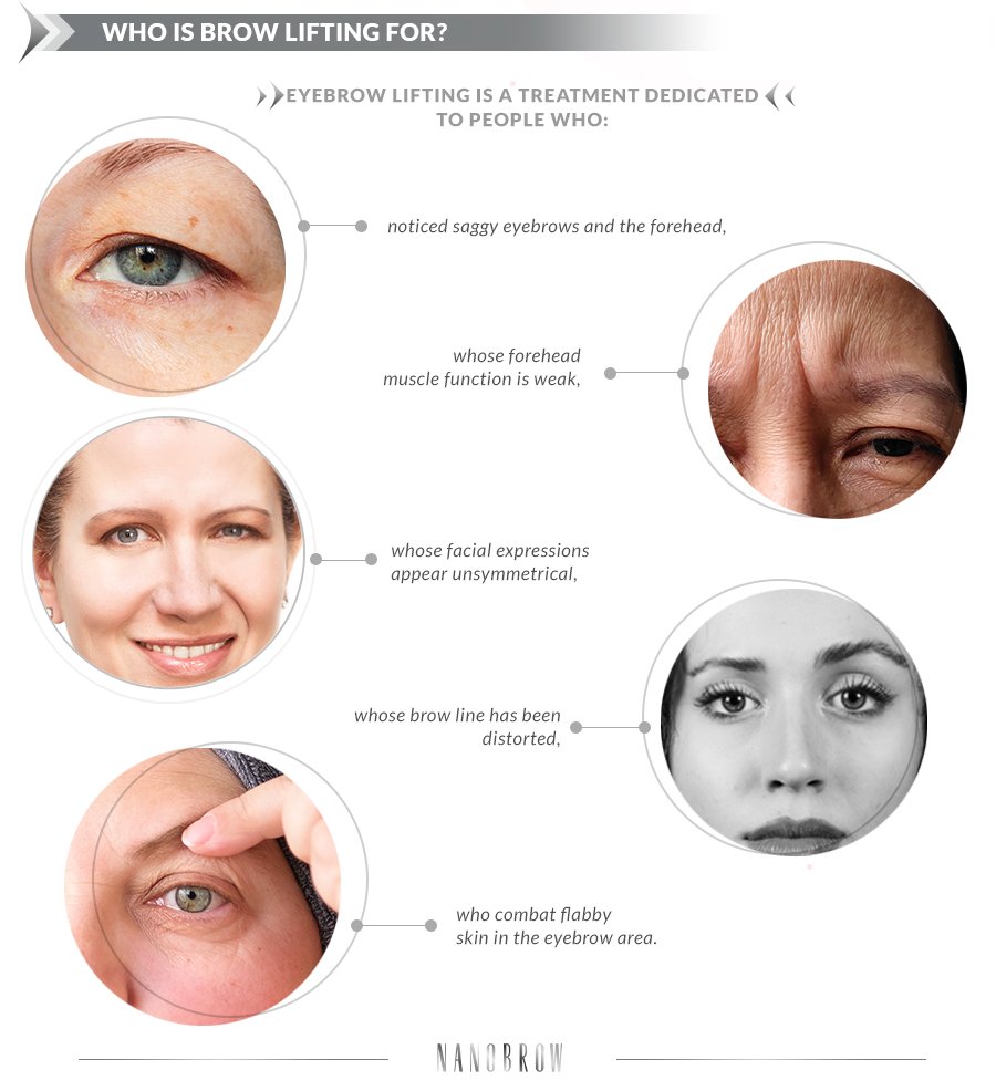 Who should have a brow lift?
